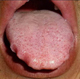 Fatty tongue with marks left by teeth
